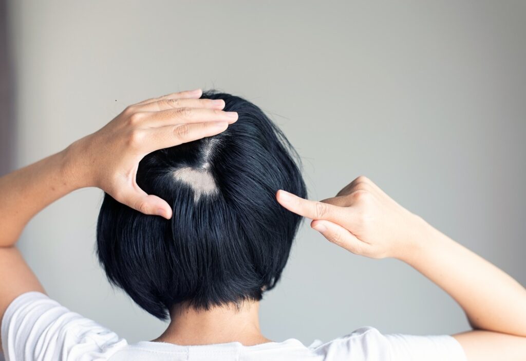Hinterkopf einer Frau mit kreisrundem Haarausfall, die mit einem Finger auf die kahle Stelle zeigt